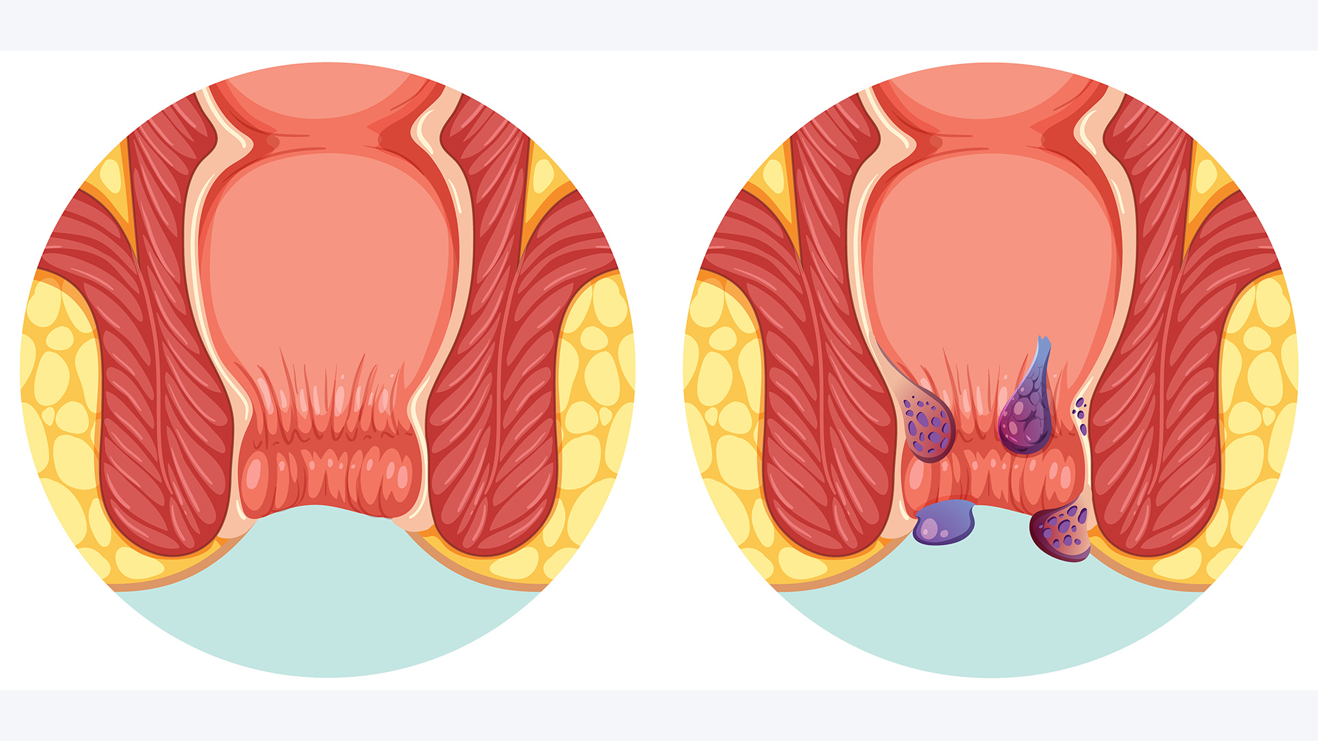 Hemoroidal Hastalık (Basur)